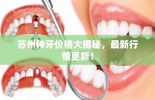 蘇州種牙價格大揭秘，最新行情更新！